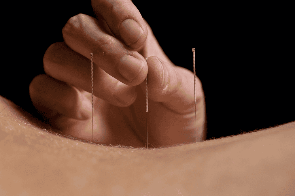 Acupuncture can releive back pain